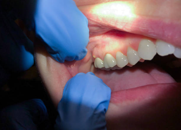 Best Knocked-Out Tooth (Avulsed Tooth) Treatment in Mclean, TX